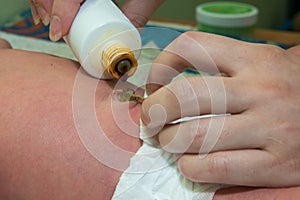 Close up umbilical cord . Mother uses it iodine.