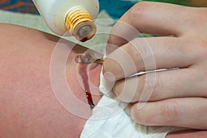 Close up umbilical cord . Mother uses it iodine.