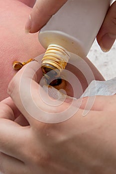 Close up umbilical cord . Mother uses it iodine.