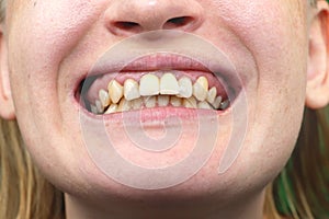 Close-up of unsuccessfully implanted dental implants