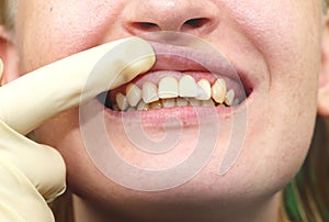 Close-up of unsuccessfully implanted dental implants