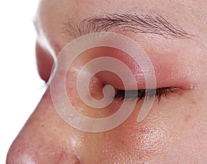 Close-up of upper eye lid swell after nose job
