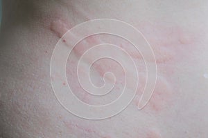 Close up of urticaria.