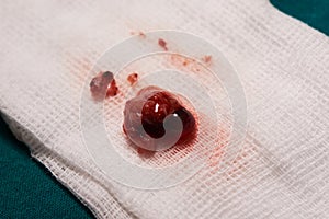 Close-up view of abnormal vascular in the brain causing seizure photo