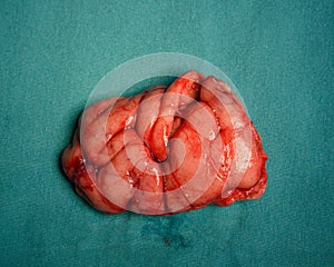 Close-up view of brain specimen after surgery
