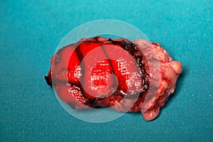 Specimen of epileptic brain from surgery photo