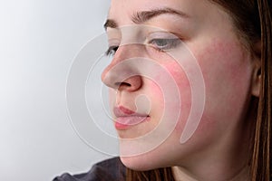 Close up view on the cheek of a woman with red cheeks after the wind. Allergy concept.