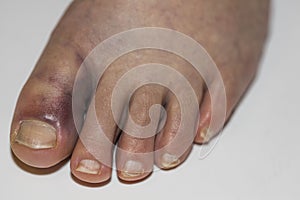 Close up view of damaged foot female with with bruise big toe. Injuries concept