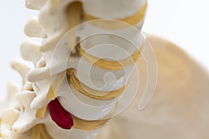 Close-up view of herniated lumbar disc model