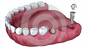 A close-up view of lower teeth and dental implants