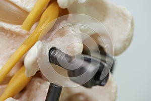 Close-up view of lumbar spine model and instrument fixation