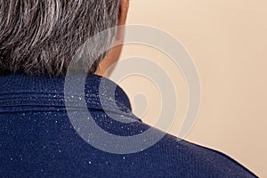 Close-up view of a man who has a lot of dandruff from his hair on his shirt and shoulders