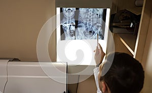 Close up view: picture of doctor exploring spinal x-ray: lumbar and cervical region photo