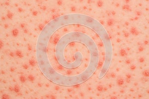 Skin Rash with Red Lesions â Close-Up of Dermatological Condition on Light Pink Surface