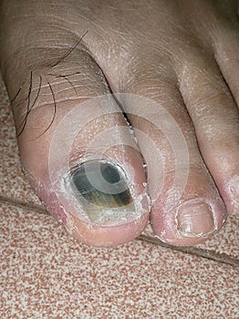 Close up view of toenail flipped and turned black photo