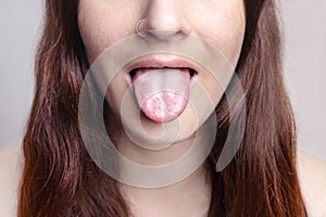 Close up view on the white furry tongue of woman. A common symptom of a candida albicans yeast infection or stomatitis