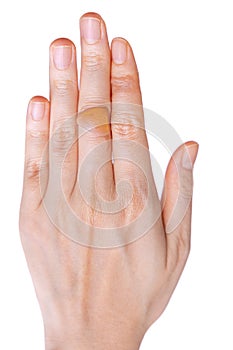 Close-up of the water blister on the finger on a white background