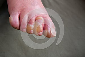 Close up of water blisters on the toes of paraplegic after serious hot water burn