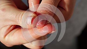 Close-up of a woman applying healing oil to a damaged detached nail, onycholysis