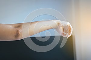 Close up of woman with dry skin on elbow and arm,Body and health care concept