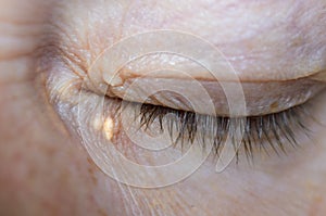 Close up of woman eyes with Xanthelasma on the eyelids. Hypercholesterolemia, high cholesterol photo