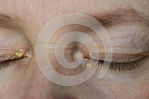 Close up of woman eyes with Xanthelasma on the eyelids. Hypercholesterolemia, high cholesterol