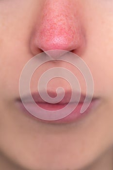 close up, woman with a red nose, allergy, hypothermia or rosacea