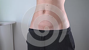 Close up of woman`s belly with cesarean scar. Postpartum recovery. Baby delivery operation. Fit woman after birth