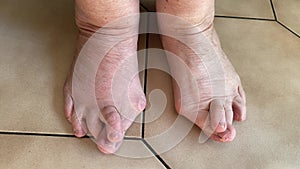 Close up of a woman`s feet with hammertoe AND BUNIONS she tries to move here toes