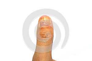 Close-up of a woman`s right thumb, with a torn or peeling nail. A broken or detached toenail. A toenail is falling off