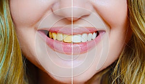 close-up. a woman's smile with a comparison of whitened and yellow teeth.