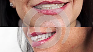 Close-up of woman's smile before and after zirconia veneers, dental ceramic crowns. Female patient smiling before