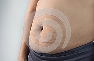 Close up of Woman showing belly skin with stretch marks and loose skin after giving birth. Health care for skin and body shape