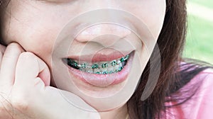 Close up woman smiling with Ceramic and Metal Braces