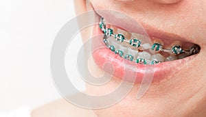 Close up woman smiling with Ceramic and Metal Braces