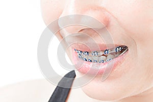 Close up woman smiling with Ceramic and Metal Braces on white ba