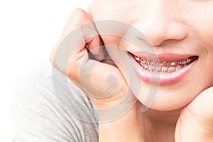 Close up woman smiling with Ceramic and Metal Braces on white ba