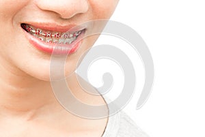 Close up woman smiling with Ceramic and Metal Braces on white ba