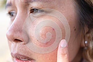 Pohled zblízka na ženy tmavý místo na sušené kůže otázky léčba. asijský střední věk ženy 