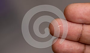 close up of wooden splinter in a man's finger