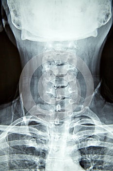 Close up x-ray film show cervical spine or c-spine, neck bones x-ray film.