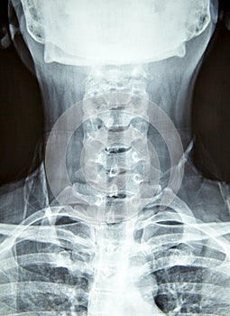 Close up x-ray film show cervical spine or c-spine, neck bones x-ray film.