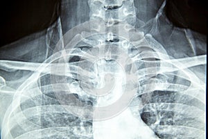 Close up x-ray film show cervical spine or c-spine, neck bones x-ray film.