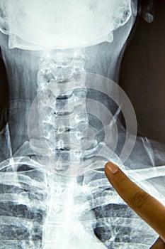 Close up x-ray film show cervical spine or c-spine, neck bones x-ray film.