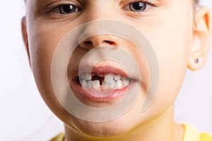 Close-up of young girl face showing missing front baby tooth looking at camera on white background. First teeth changing