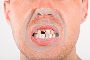 Close up of young man with missing teeth. Health care