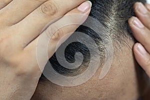 Close Up Young people have problems with hair loss, dryness, dullness, split ends and damage