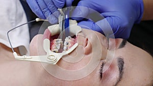 Close up of young woman with dental retractor on dentistry treatment. Orthodontist fixes ligature braces on teeth of