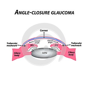 Closed angle glaucoma. A common type of glaucoma. The anatomical structure of the eye. Infographics. Vector illustration