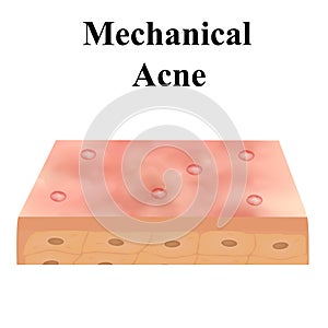 Closed comedones. Acne on the skin. Dermatological and cosmetic diseases on the skin of the face acne. Infographics